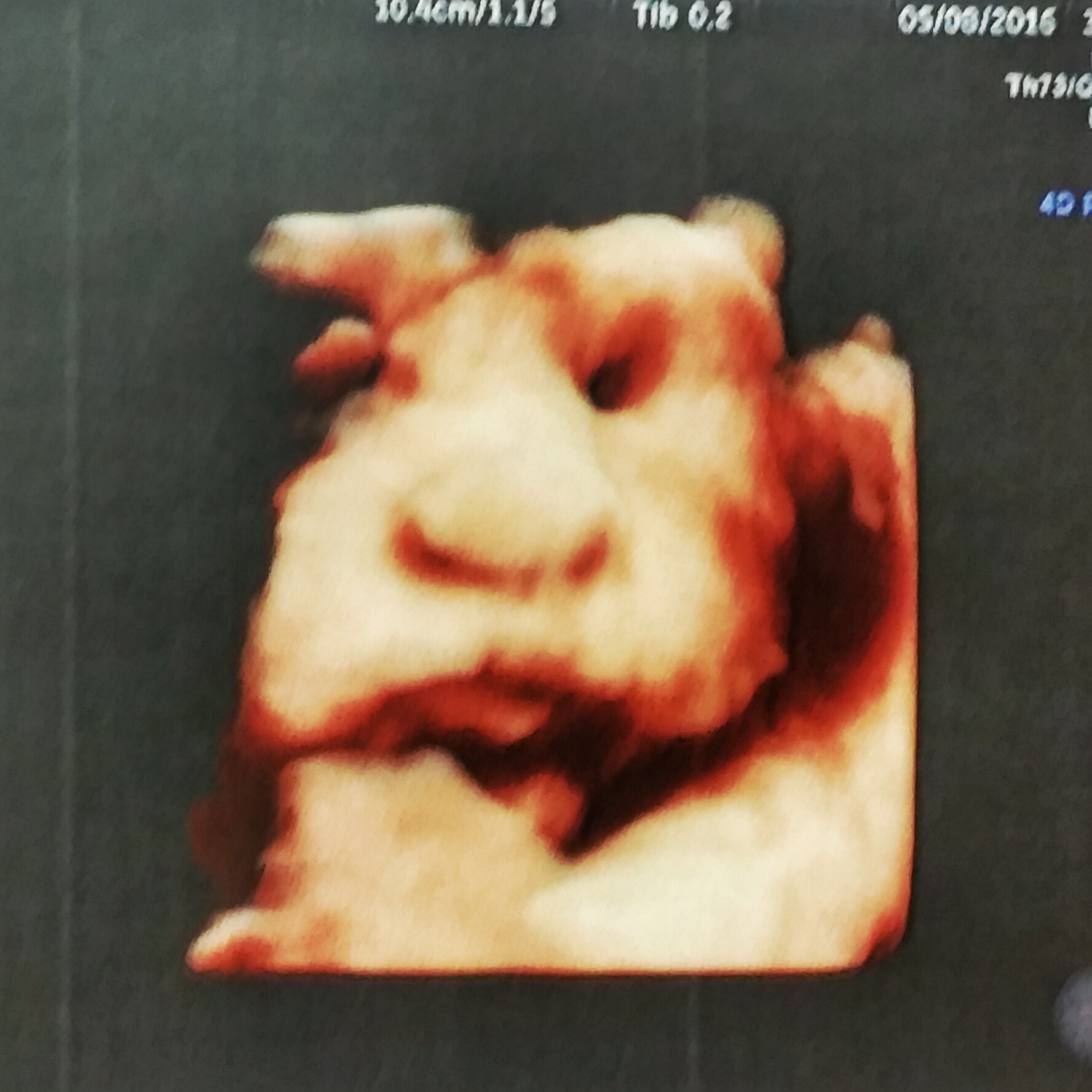 3d Ultrasound.jpeg