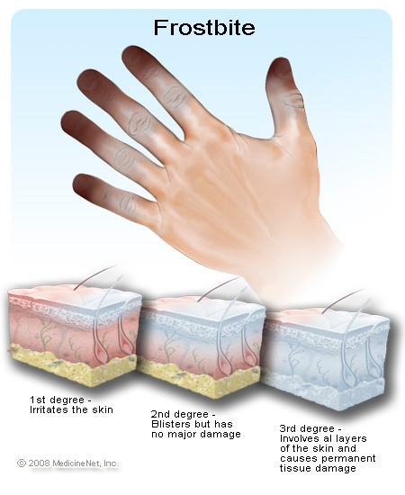 frostbite-diagram.jpg